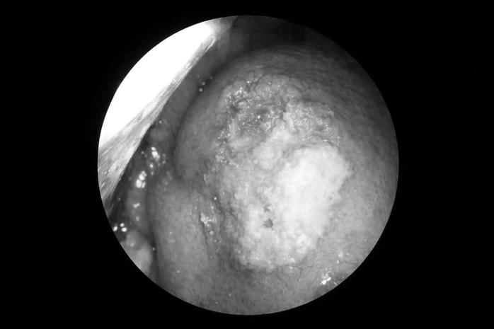 Vết loét nhỏ tưởng vô hại, hóa ung thư lưỡi